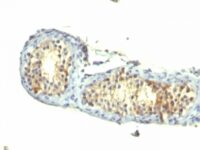 Formalin-fixed, paraffin-embedded human Testicular Carcinoma stained with TGF alpha Monoclonal Antibody (1E8-G6)