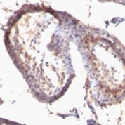 Formalin-fixed, paraffin-embedded human Testicular Carcinoma stained with TGF alpha Monoclonal Antibody (SPM542)