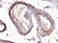 Formalin-fixed, paraffin-embedded human Testicular Carcinoma stained with TGF alpha Monoclonal Antibody (SPM542)