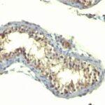 Formalin-fixed, paraffin-embedded human Testicular Carcinoma stained with TGF alpha Monoclonal Antibody (TG86)