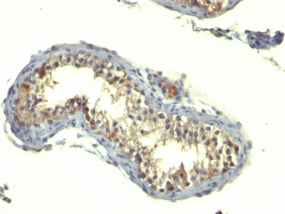 Formalin-fixed, paraffin-embedded human Testicular Carcinoma stained with TGF alpha Monoclonal Antibody (TG86)