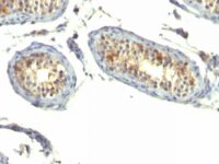 Formalin-fixed, paraffin-embedded human Testicular Carcinoma stained with TGF alpha Monoclonal Antibody (P/T1)