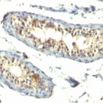 Formalin-fixed, paraffin-embedded human Testicular Carcinoma stained with TGF alpha Monoclonal Antibody (TG86 + P/T1)