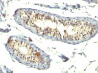 Formalin-fixed, paraffin-embedded human Testicular Carcinoma stained with TGF alpha Monoclonal Antibody (TG86 + P/T1)