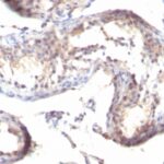 Formalin-fixed, paraffin-embedded human Testicular Carcinoma stained with TGF alpha Monoclonal Antibody (TGFA/1119)