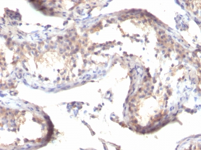 Formalin-fixed, paraffin-embedded human Testicular Carcinoma stained with TGF alpha Monoclonal Antibody (TGFA/1119)