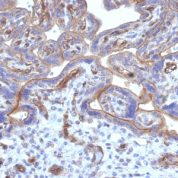 Formalin-fixed, paraffin-embedded human Cervical Carcinoma stained with Thrombomodulin/CD141 Monoclonal Antibody (THBD/1782).