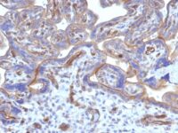 Formalin-fixed, paraffin-embedded human Cervical Carcinoma stained with Thrombomodulin/CD141 Monoclonal Antibody (THBD/1782).