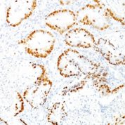 Formalin-fixed, paraffin-embedded human Thyroid stained with TTF-1 Monoclonal Antibody (8G7G3/1)