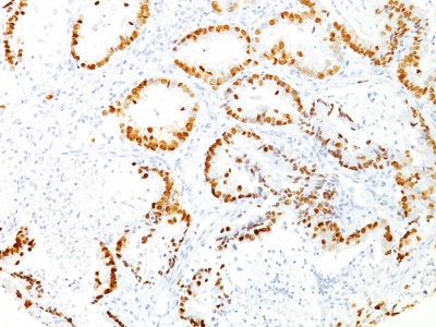 Formalin-fixed, paraffin-embedded human Thyroid stained with TTF-1 Monoclonal Antibody (8G7G3/1)