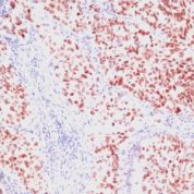 Formalin-fixed, paraffin-embedded human Lung Carcinoma stained with TTF-1 Monoclonal Antibody (SPM15)