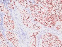 Formalin-fixed, paraffin-embedded human Lung Carcinoma stained with TTF-1 Monoclonal Antibody (SPM15)