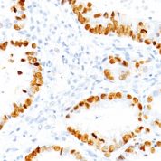 Formalin-fixed, paraffin-embedded human Thyroid stained with TTF-1 Monoclonal Antibody (NX2.1/69)