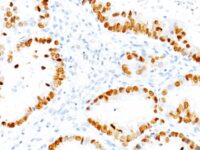 Formalin-fixed, paraffin-embedded human Thyroid stained with TTF-1 Monoclonal Antibody (NX2.1/69)