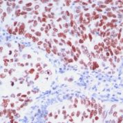 Formalin-fixed, paraffin-embedded human Thyroid stained with TTF-1 Monoclonal Antibody (8G7G3/1 + NX2.1/69)