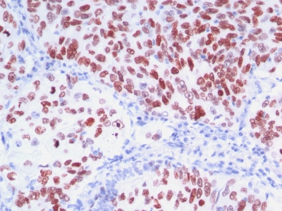 Formalin-fixed, paraffin-embedded human Thyroid stained with TTF-1 Monoclonal Antibody (8G7G3/1 + NX2.1/69)