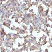 Formalin-fixed, paraffin-embedded human Erdheim Chester disease (also known as polyostotic lerosing histiocytosis) stained with TNF alpha Monoclonal Antibody (TNFA/1172).