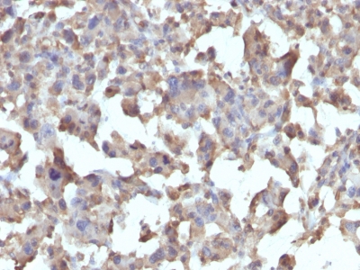 Formalin-fixed, paraffin-embedded human Erdheim Chester disease (also known as polyostotic lerosing histiocytosis) stained with TNF alpha Monoclonal Antibody (TNFA/1172).