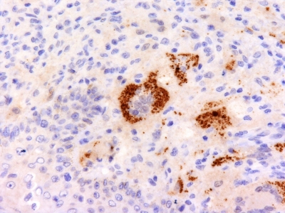Formalin-fixed, paraffin-embedded human Erdheim Chester disease (also known as polyostotic sclerosing histiocytosis) stained with TNF alpha Monoclonal Antibody (P/T2).