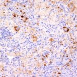 Formalin-fixed, paraffin-embedded human Erdheim Chester disease (also known as polyostotic sclerosing histiocytosis) stained with TNF alpha Monoclonal Antibody (TNF76 + P/T2).