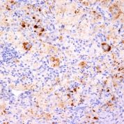 Formalin-fixed, paraffin-embedded human Erdheim Chester disease (also known as polyostotic sclerosing histiocytosis) stained with TNF alpha Monoclonal Antibody (TNF76 + P/T2).