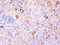 Formalin-fixed, paraffin-embedded human Erdheim Chester disease (also known as polyostotic sclerosing histiocytosis) stained with TNF alpha Monoclonal Antibody (TNF76 + P/T2).