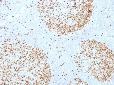 Formalin-fixed, paraffin-embedded Human Bladder Carcinoma stained with Topoisomerase II alpha Monoclonal Antibody (TOP2A/1361).