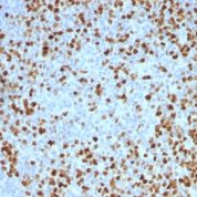 Formalin-fixed, paraffin-embedded Human Bladder Carcinoma stained with Topoisomerase II alpha Monoclonal Antibody (TOP2A/1362).