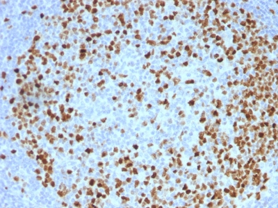 Formalin-fixed, paraffin-embedded Human Bladder Carcinoma stained with Topoisomerase II alpha Monoclonal Antibody (TOP2A/1362).