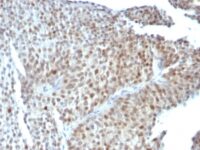 Formalin-fixed, paraffin-embedded human Bladder Carcinoma stained with p53 Monoclonal Antibody (SPM589).