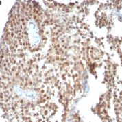 Formalin-fixed, paraffin-embedded human Colon Carcinoma stained with p53 Monoclonal Antibody (SPM59)