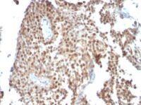 Formalin-fixed, paraffin-embedded human Colon Carcinoma stained with p53 Monoclonal Antibody (SPM59)