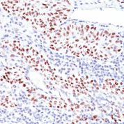 Formalin-fixed, paraffin-embedded human Bladder Carcinoma stained with p53 Monoclonal Antibody (TRP/816).