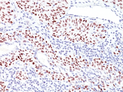 Formalin-fixed, paraffin-embedded human Bladder Carcinoma stained with p53 Monoclonal Antibody (TRP/816).