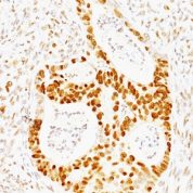 Formalin-fixed, paraffin-embedded human Colon Carcinoma stained with p53 Monoclonal Antibody (TRP/817)