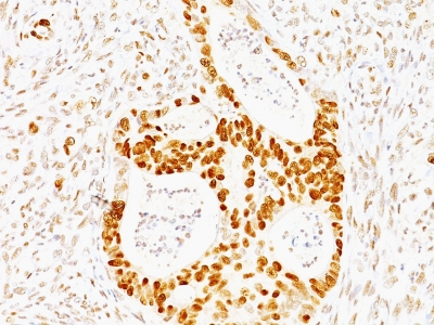 Formalin-fixed, paraffin-embedded human Colon Carcinoma stained with p53 Monoclonal Antibody (TRP/817)