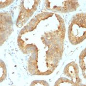 Formalin-fixed, paraffin-embedded human Breast Carcinoma stained with GRP94 Monoclonal Antibody (9G1.F8.2).