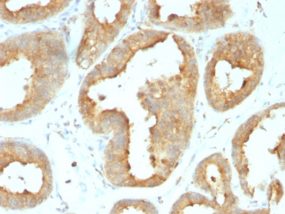 Formalin-fixed, paraffin-embedded human Breast Carcinoma stained with GRP94 Monoclonal Antibody (9G1.F8.2).