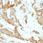 Formalin-fixed, paraffin-embedded human Breast Carcinoma stained with GRP94 Monoclonal Antibody (SPM249).