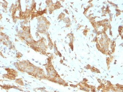 Formalin-fixed, paraffin-embedded human Breast Carcinoma stained with GRP94 Monoclonal Antibody (SPM249).