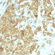 Formalin-fixed, paraffin-embedded human Breast Carcinoma stained with GRP94 Monoclonal Antibody (HSP9B1/1192).