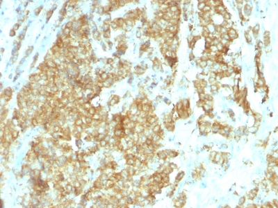 Formalin-fixed, paraffin-embedded human Breast Carcinoma stained with GRP94 Monoclonal Antibody (HSP9B1/1192).