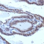 Formalin-fixed, paraffin-embedded human Thyroid Carcinoma stained with TSHRA Monoclonal Antibody (SPM223).