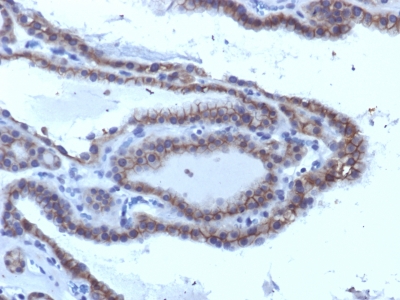 Formalin-fixed, paraffin-embedded human Thyroid Carcinoma stained with TSHRA Monoclonal Antibody (SPM223).