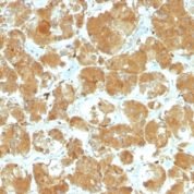 Formalin-fixed, paraffin-embedded human Thyroid Carcinoma stained with TSH Receptor, A-Chain MAb (TSHRA/142).