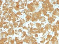 Formalin-fixed, paraffin-embedded human Thyroid Carcinoma stained with TSH Receptor, A-Chain MAb (TSHRA/142).