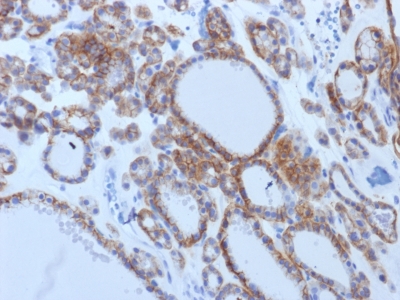 Formalin-fixed, paraffin-embedded human Thyroid Carcinoma stained with TSHRB Monoclonal Antibody (TSHRB/145).
