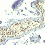 Formalin-fixed, paraffin-embedded human Testicular Carcinoma stained with Thymidylate Synthase Monoclonal Antibody (TS16).