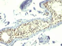 Formalin-fixed, paraffin-embedded human Testicular Carcinoma stained with Thymidylate Synthase Monoclonal Antibody (TS16).