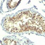 Formalin-fixed, paraffin-embedded human Testicular Carcinoma stained with Thymidylate Synthase Monoclonal Antibody (TMS715).